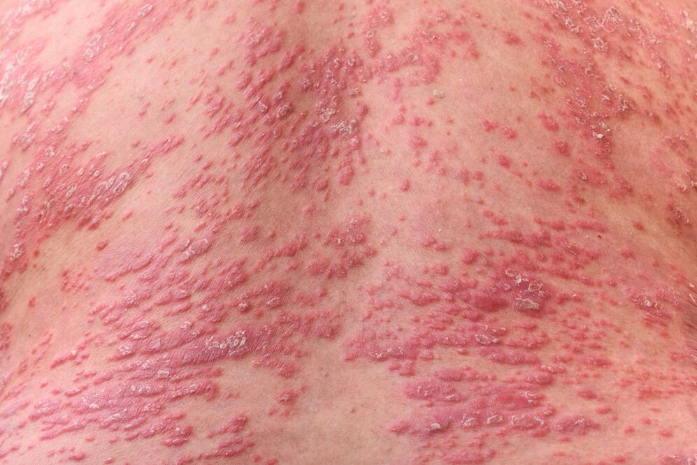 Cén chuma atá ar psoriasis 