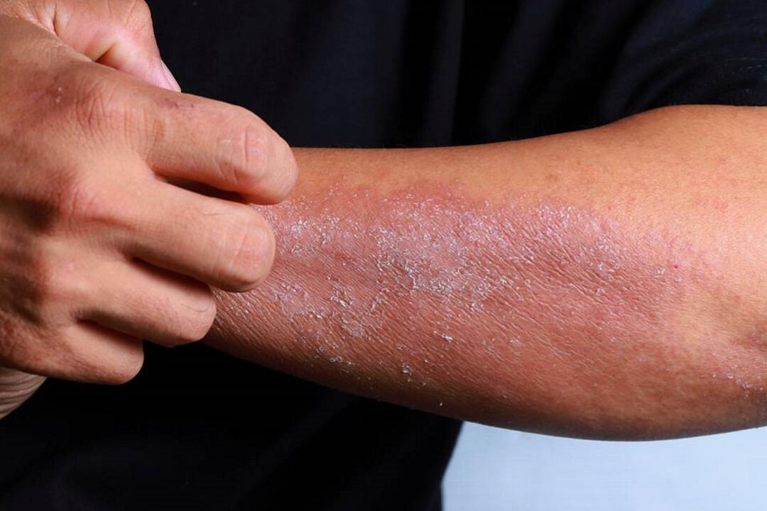 comharthaí psoriasis